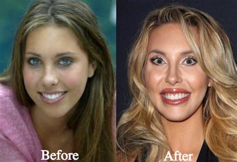 chloe lattanzi plastic|chloe lattanzi before after.